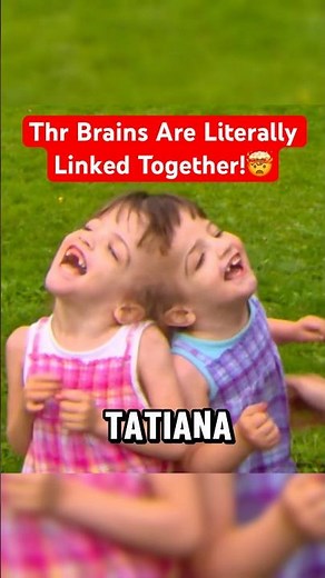 The Twins Who Share One Brain