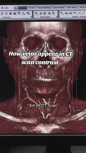 When a contrast CT scan of the head is performed, it can help visualize various structures and potential abnormalities. Here are some possible findings when a contrast CT scan of the head shows veins: 1. *Normal veins*: Contrast agent highlights normal venous structures, such as the superior sagittal sinus, transverse sinuses, and jugular veins. 2. *Venous thrombosis*: Contrast CT scan can reveal blood clots within the veins, which may appear as filling defects or blockages. 3. *Venous malformat