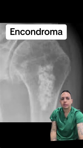 Encondroma: Tumor Benigno en Húmero