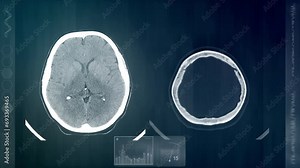 MRI scan of a human head and brain. Computer display showing MRI scan results Stock Video
