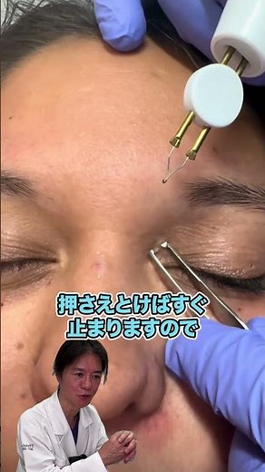 [Skin Tags] Treatment involves pulling the skin growths and burning them with an electric scalpel...