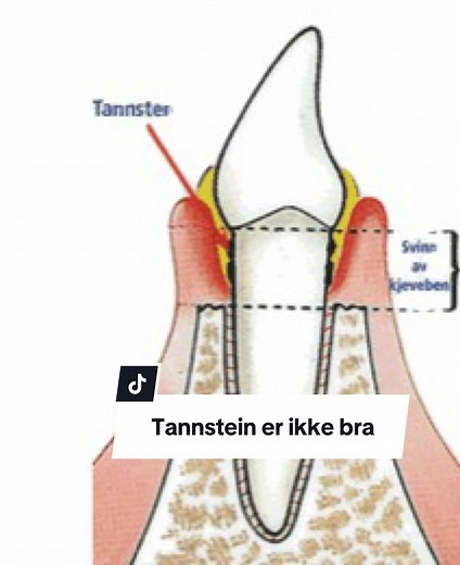 Hvorfor vi må rense tennene oftere