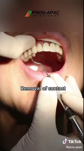Veneer Cementation using BISCO Choice 2 Techniques