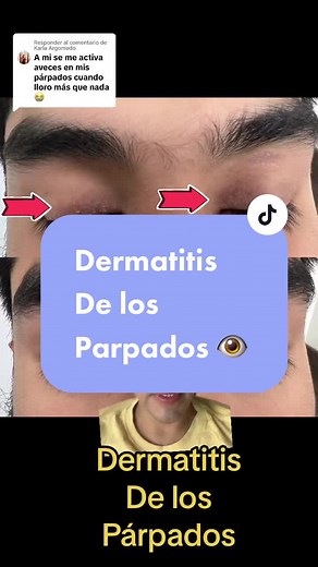 Dermatitis de los Párpados: Causas y Tratamientos