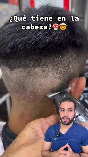 ¿Qué es la dermatitis en la cabeza?