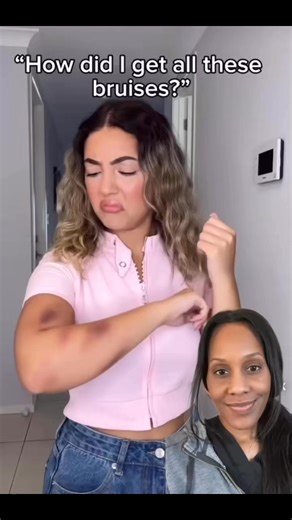 32K views · 340 reactions | Why do bruises happen? Thank you nariman.dein for sharing your story. #bruise #bruising | Dr. Jen Caudle | Facebook