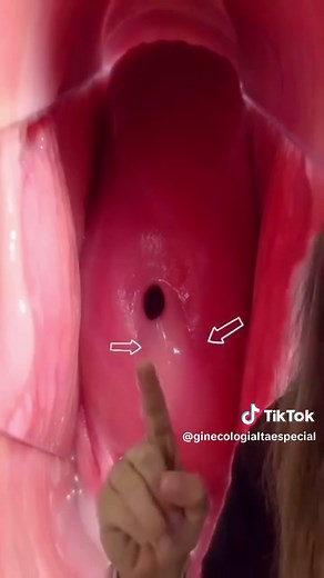 Cómo Identificar un Cuello Uterino Sano