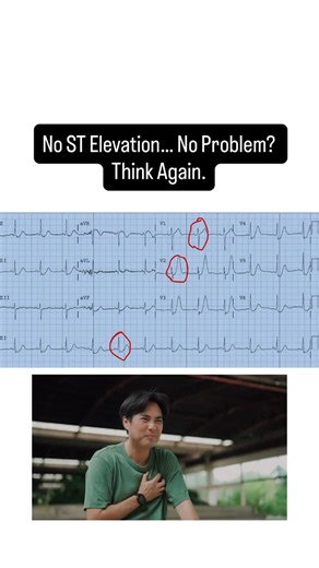 Learn ECGs Fast | JMD Medical Ed on Instagram: "He walked in clutching his chest. Pain for an hour. Sweaty. Pale. ECG printed and someone said, “Not a STEMI. There’s no ST elevation.” That’s the sentence that almost killed him. Because this ECG is a STEMI the kind that hides behind fake calm. It’s called De Winter’s Pattern, and it’s the LAD before it bursts. See these? Upsloping ST depressions > 1 mm at the J point across V2 to V6 rising uphill into tall, peaked T waves that look too proud to b