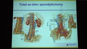 Total en bloc Spondylectomy for Locally Aggressive and Primary Malignant Tumors of The Lumbar Spine
