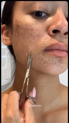 Post inflammatory hyperpigmentation improvement by this chemical peel ￼
