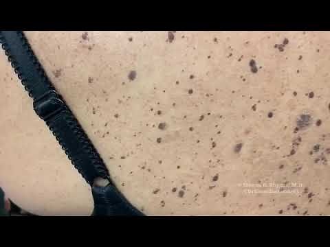 Removal of pigmented seborrheic keratosis
