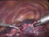 Thoracoscopic lung surgery • Video • MEDtube.net
