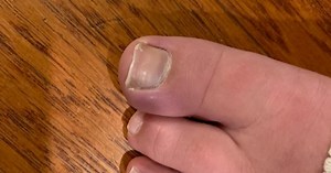 Painful & discolored: Akron Children's Hospital reports about 20 cases of 'COVID Toes'