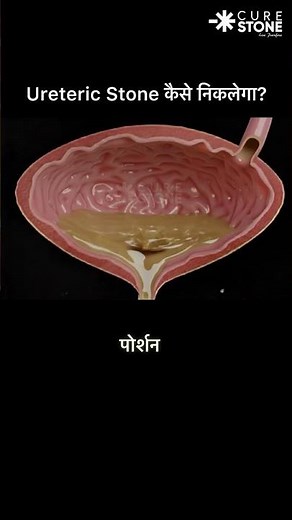 Kidney Stone Passing Through Ureter to Bladder | How Kidney Stones Come Out Naturally
