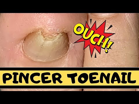 Pincer Toenail: Toenail Deformity Removal
