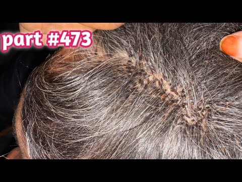 #LiceRemoval ASMR 😱 | Wife Removes Husband’s Lice from Black Hair | Deep Cleaning EP473
