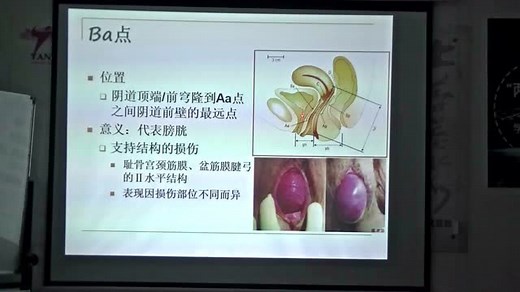 1，POP-Q分期的临床意义