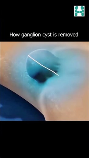 How a Ganglion Cyst Is Removed #GanglionCyst #GanglionCystRemoval #CystRemoval #MedicalProcedure