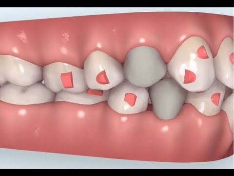 Come si applicano gli attachment nel trattamento Invisalign