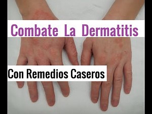 Combate la dermatitis con remedios caseros