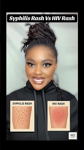 differences between syphilis rash and HIV rash