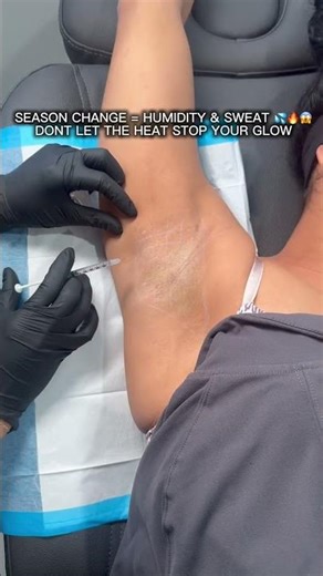 Underarm Botox | @lexxinjects