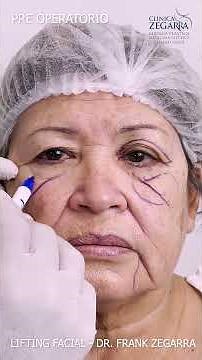 LIFTING FACIAL- EXPLICACIÓN DEL PROCEDIMIENTO - DR. FRANK ZEGARRA