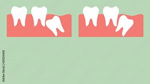 type of wisdom tooth - mesial impaction, distal impaction, horizontal impaction, vertical impaction - dental cartoon vector flat render 2d animation in 4K