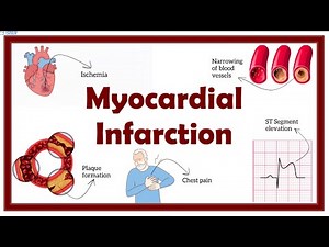 Myocardial Infarction (MI,Heart Attack)Treatment in Emergency | Step wise explanation Easy mnemonic