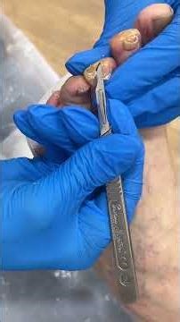 Apical Callus | Removal Reveals Ulcer #foothealth #podiatryclinic #foot #callustreatment #podiatry