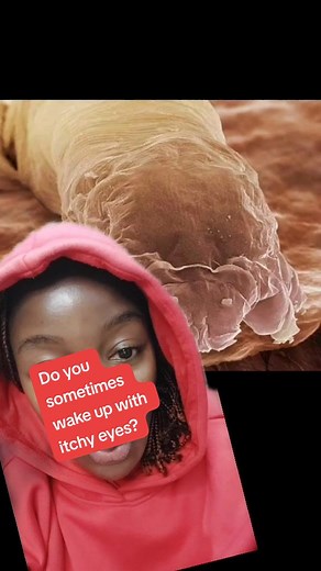 #greenscreen Demodex is a microscopic mite that lives on our face. it's basically harmless but too much of it can lead to itchy eyes and sometimes can affect skin too. #givenshakira #skincareug #skincaretips