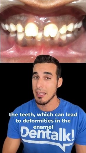 😲Incredible DENTAL MALFORMATION due to SYPHILIS - MULBERRY molars and HUTCHINSON teeth