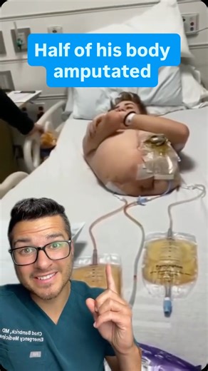 Dr. Chad on Instagram: "A hemicorporectomy is a last-resort, life-saving procedure where the body is surgically separated through the lower lumbar spine—removing everything below the waist, including the pelvis and legs. It’s considered only when there’s no other option to prevent certain death, typically in cases of uncontrollable pelvic infections, aggressive cancers, or severe trauma where the lower body can no longer support life. What makes this surgery so unique is that surgeons must rerou