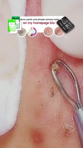 #acnepopper #acneremoval #oddlysatisfying #acne #pimple #pimplepopper2021 wow