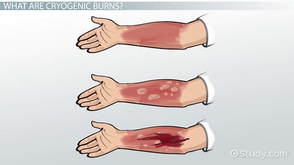 Cryogenic Burn | Definition, Symptoms & Treatment