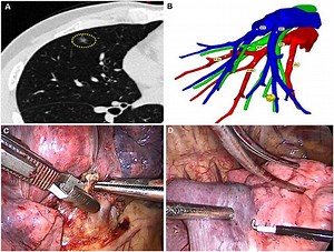 Vein or artery-first resection in right middle lobe segmentectomy: which preserves more lung?