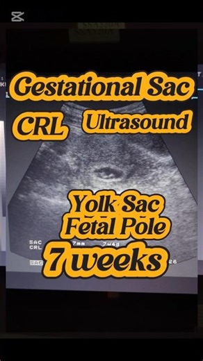 GS CRL FCA Ultrasound | Fetal Pole and Yolk Sac Ultrasound | Crown Rump Length | Gestational Sac