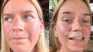 Rare Reaction to Spider Bite Left Woman Swollen, in Pain & Begging for Help