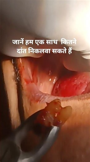🦷 4 teeth extracted in one go | Upper Right Multiple Tooth Extraction#shorts #TheDentalGuru#dentist