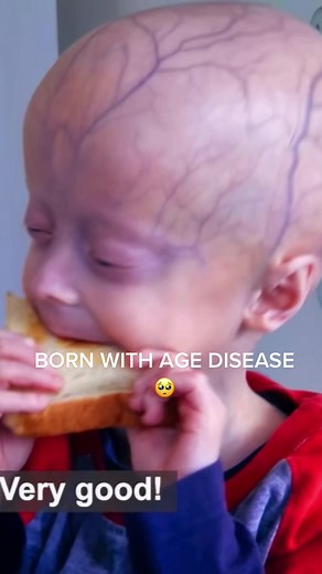 Understanding Progeria: A Rare Aging Condition Explained