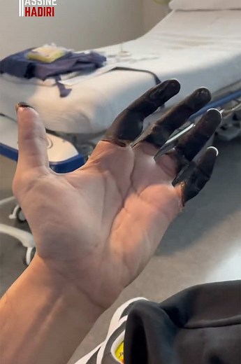 قضمة الصقيع Frostbite وموت الخلايا Necrosis/Apoptosis #علوم #بيولوجيا #صحة