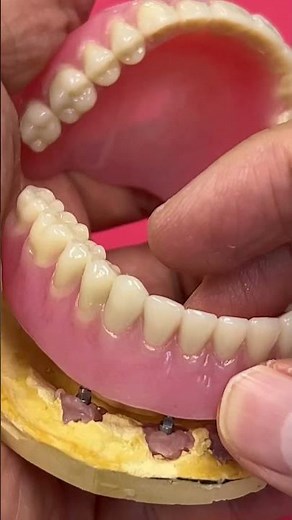 Overdenture with Mini Implants