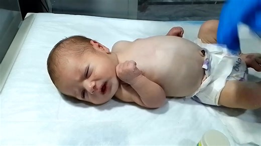 172K views · 2.4K reactions | "Neonate Baby Passing Suppository |...