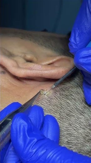 Wart Removal in Mumbai by Dr. Vishal Patel - RF Cautery Technique