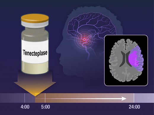 In ischemic stroke, tenecteplase may provide benefit when administered within 4.5 hours after the time the patient was last known to be well, but its safety and efficacy when administered at 4.5 to 24 hours are unclear. Research findings are summarized in this new Quick Take video. https://nej.md/3wa2tAR | The New England Journal of Medicine