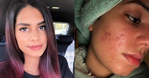 "Most days, I'd just cry." How microneedling helped Leah's skin when it changed overnight.