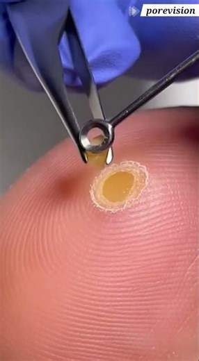 Dead Foot Corn Removal | Core Extraction 4K #satisfying