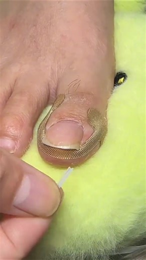 Simple Care for Ingrown Toenails and Foot Health