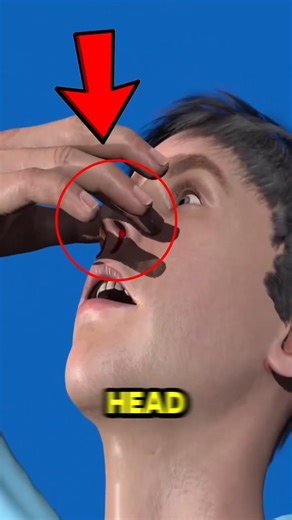 Nosebleed? Don’t Do This!