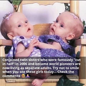Conjoined twin sisters who were famously ”cut in half” in 2006 and became world pioneers are now living as separate adults. Try not to smile when you see these girls today... Check the comments 🥹🙏🏻 | Dogs World